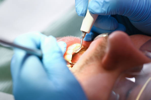 Best Emergency Root Canal Treatment in Summerde, AL
